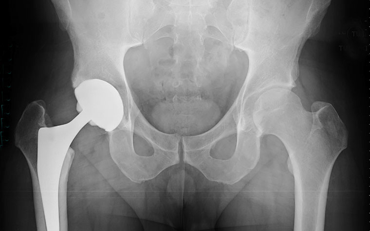 X-Ray of Hips